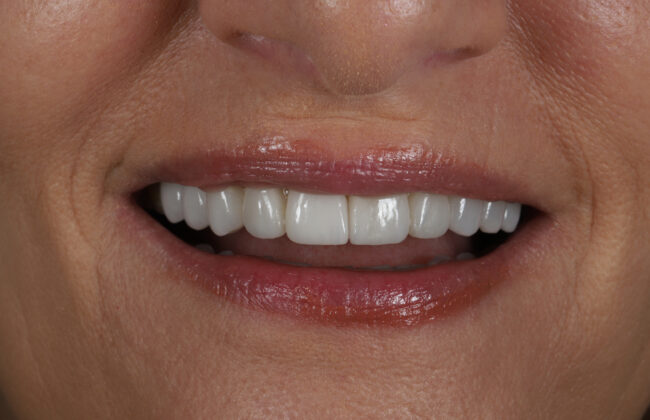 After (Teeth)