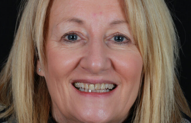 Before (Teeth)