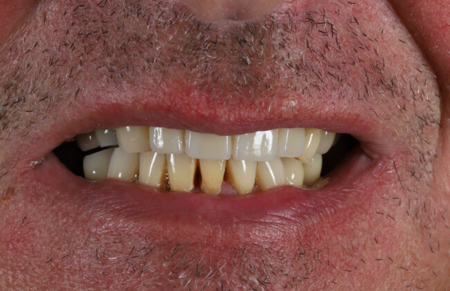 After (Teeth)