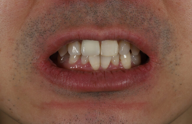 After (Teeth)