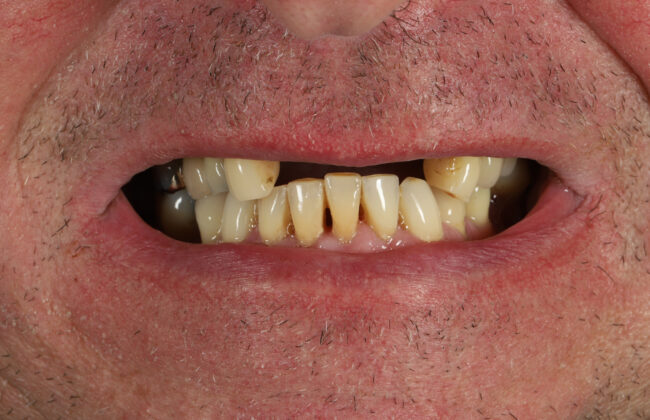 Before (Teeth)