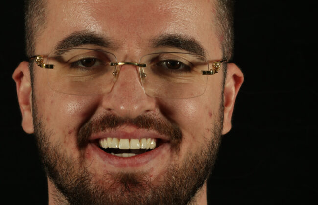 After (Teeth)