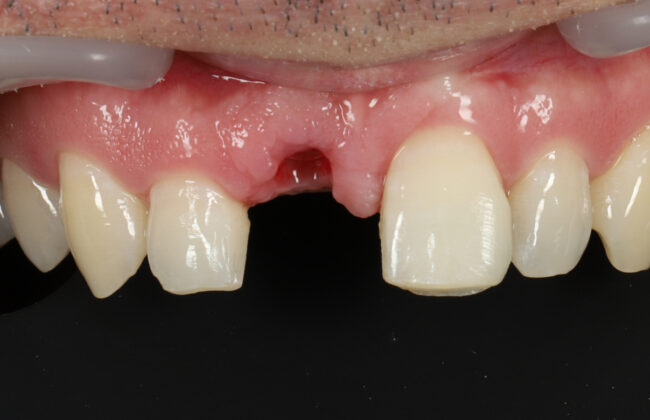 Before (Teeth)
