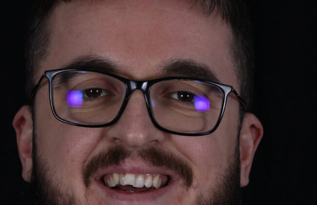 Before (Teeth)