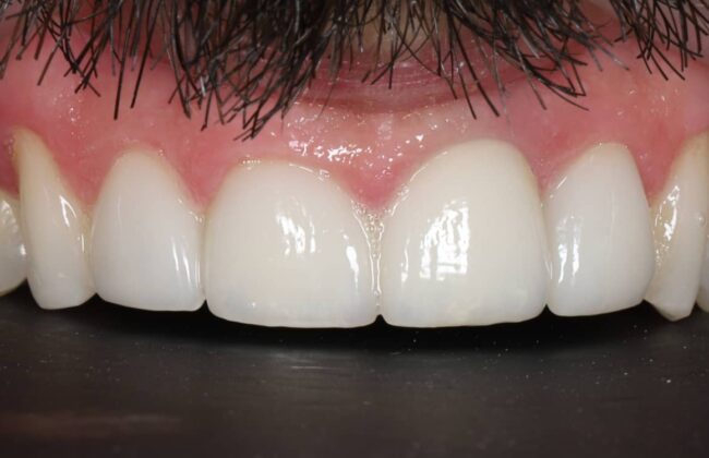 After (Teeth)