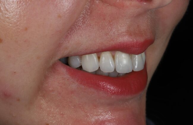 After (Teeth)