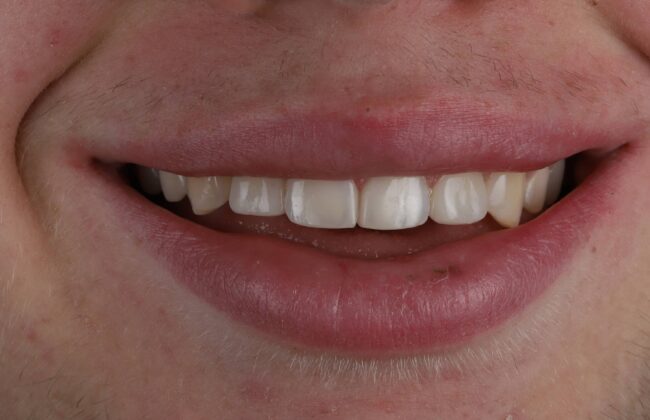 After (Teeth)