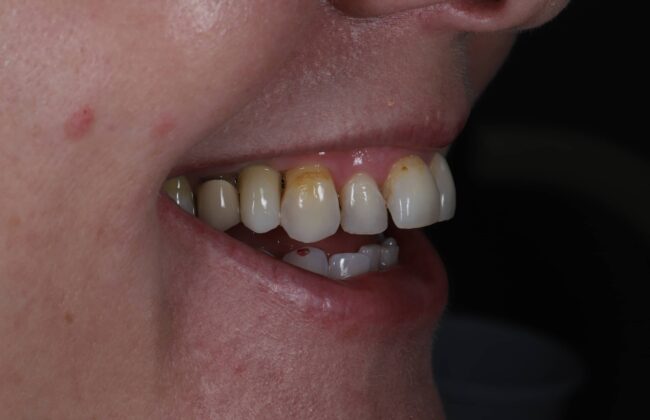 After (Teeth)