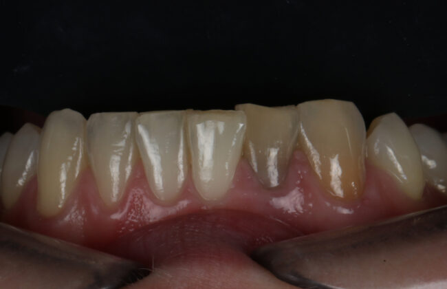 Before