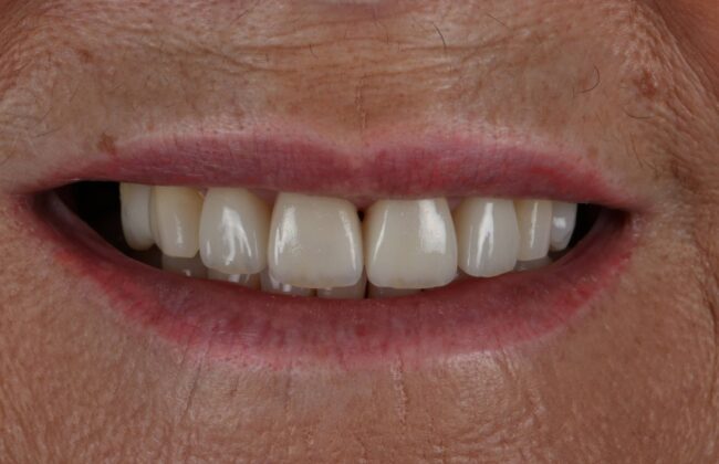 After (Teeth)