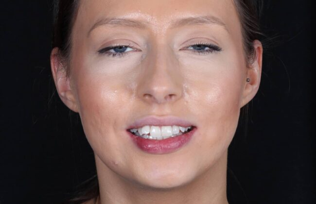 Before (Teeth)