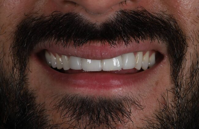 After (Teeth)