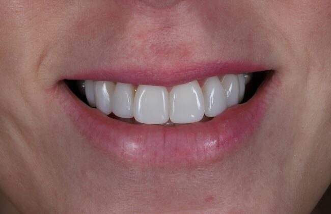 After (Teeth)