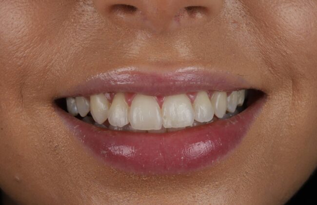 After (Teeth)