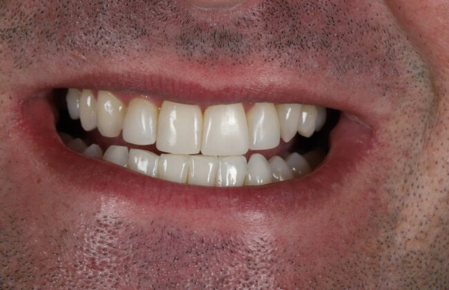After (Teeth)