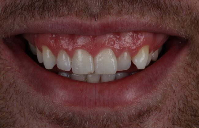Before (Teeth)