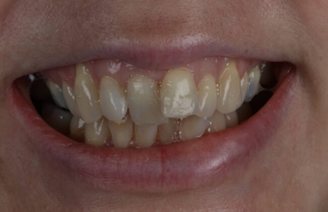 Before (Teeth)