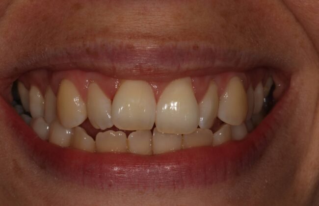 Before (Teeth)