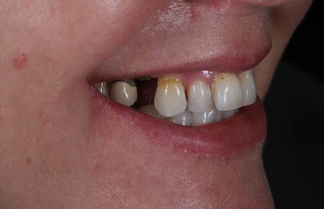 Before (Teeth)