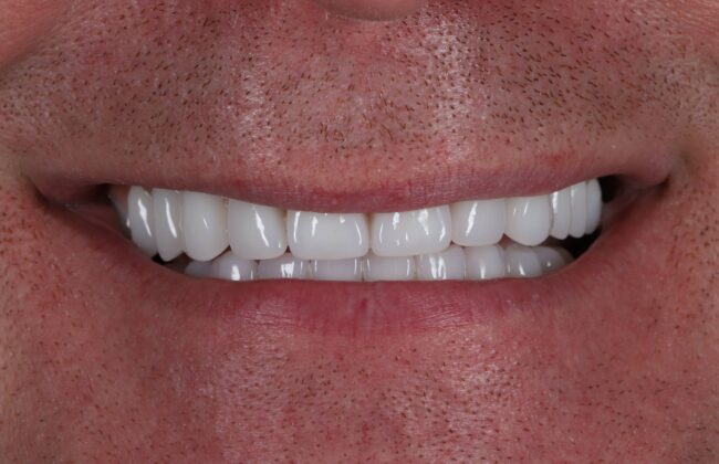 After (Teeth)