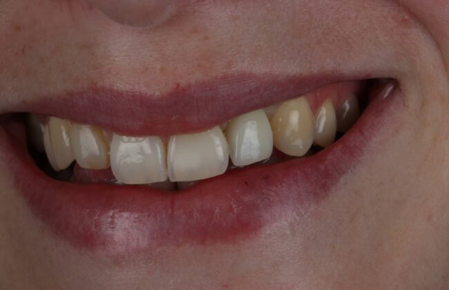 After (Teeth)