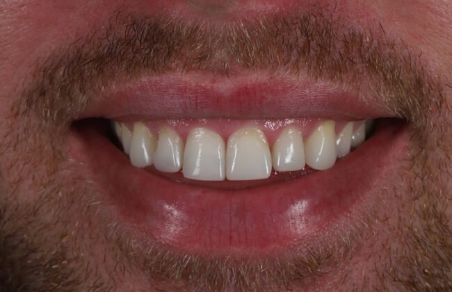 After (Teeth)