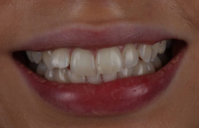 Before (Teeth)