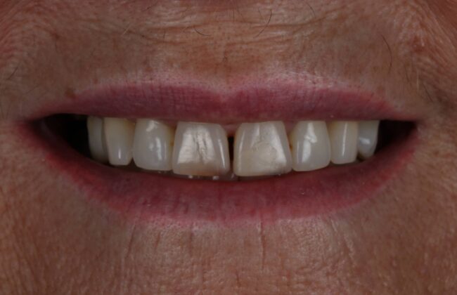 Before (Teeth)
