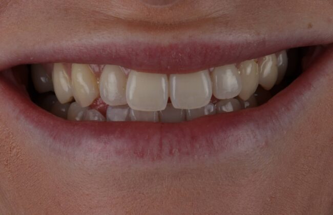 Before (Teeth)