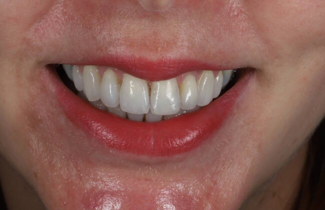 After (Teeth)