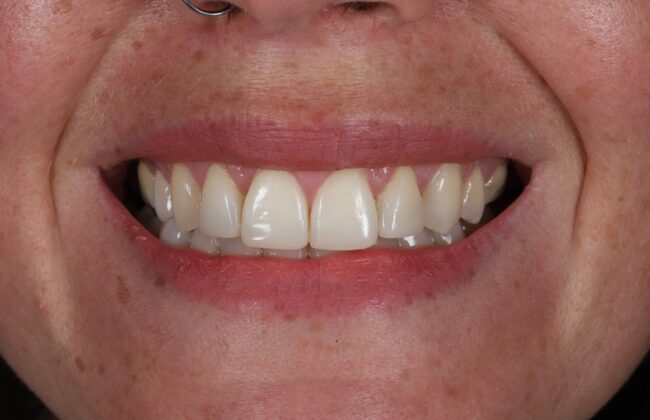 After (Teeth)