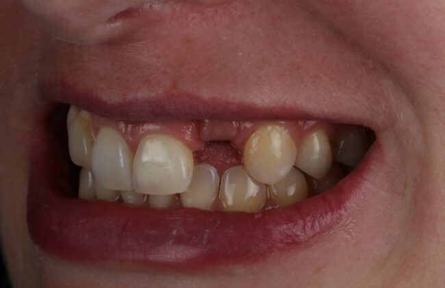 Before (Teeth)