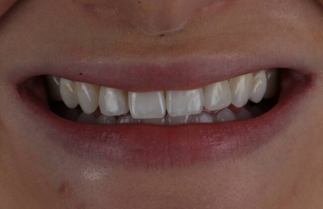 After (Teeth)