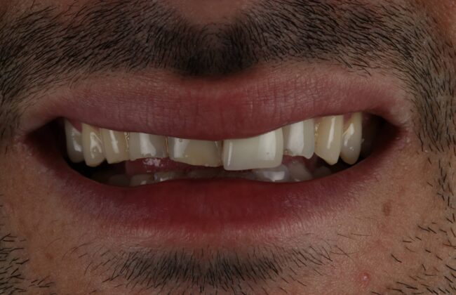 Before (Teeth)