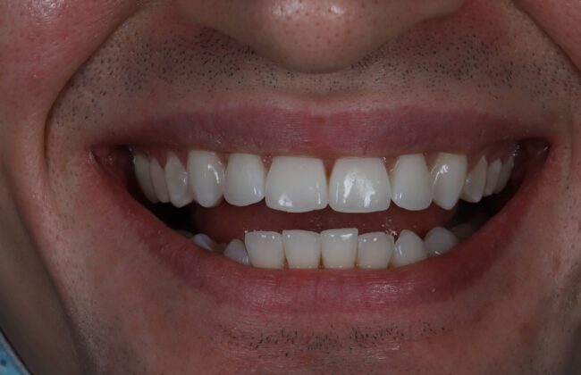 After (Teeth)