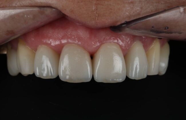 After (Teeth)