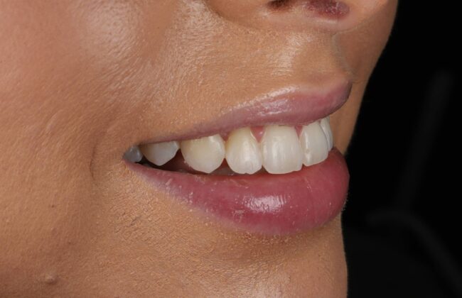 After (Teeth)
