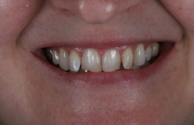 Before (Teeth)