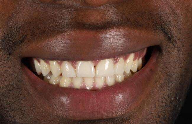 After (Teeth)