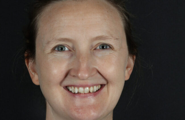 Before (Teeth)