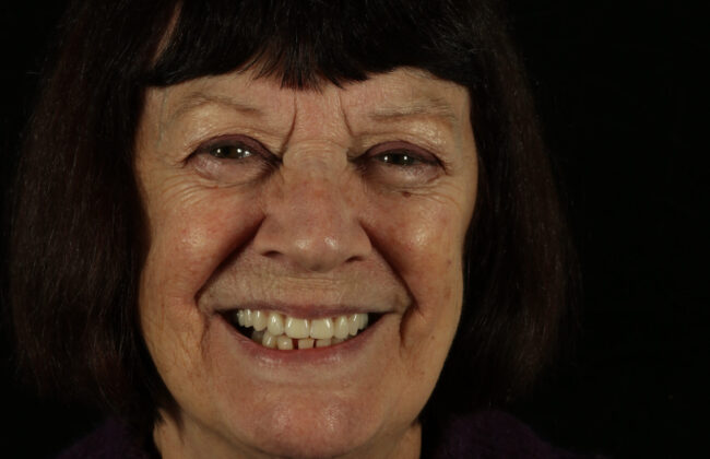 After (Teeth)