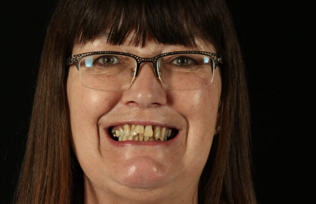 Before (Teeth)
