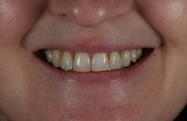 After (Teeth)