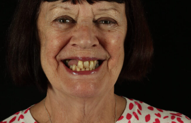 Before (Teeth)