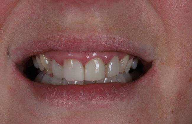 Before