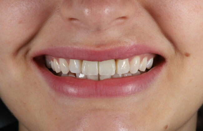 After (Teeth)