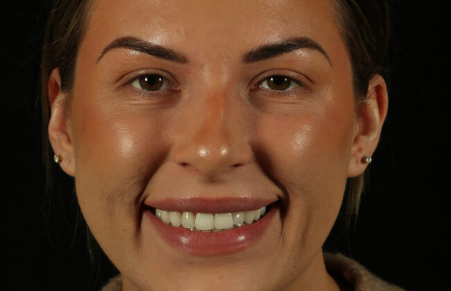 After (Teeth)