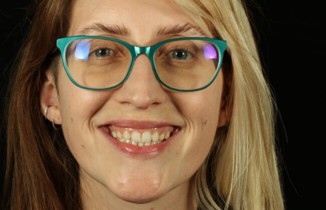 After (Teeth)
