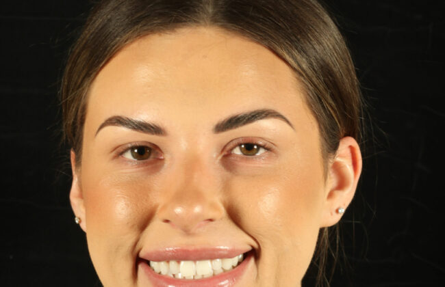 Before (Teeth)